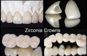 Zirconia Crown - DentCare Dental