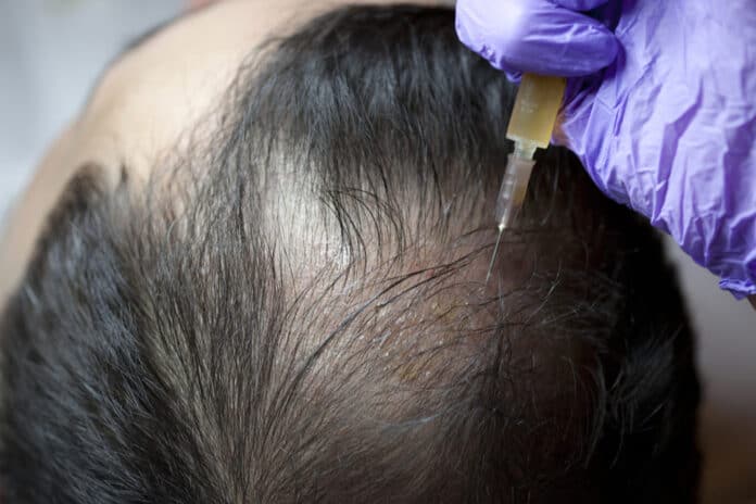 PRP hair treatment cost