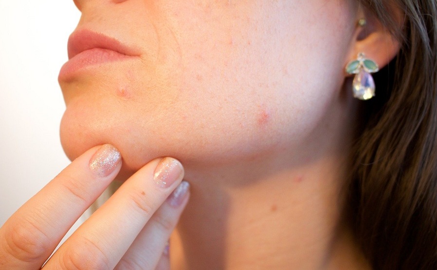 Acne During Pregnancy: How to Treat It Safely