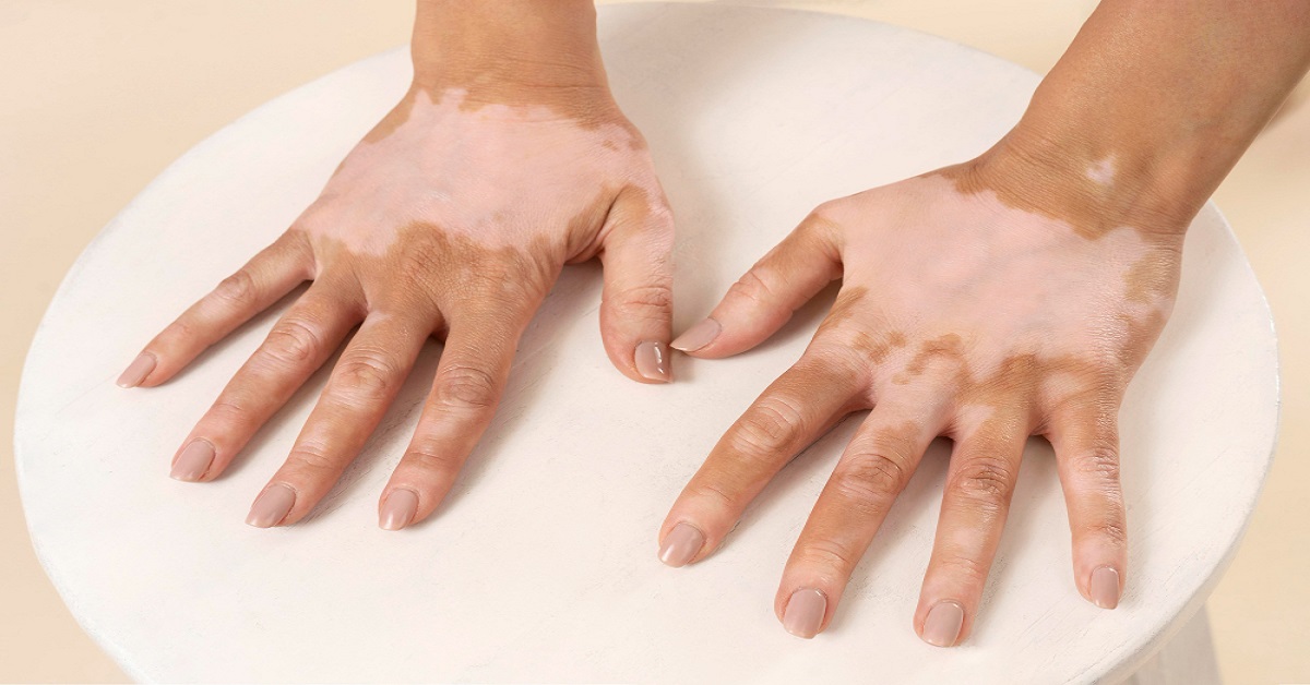 Vitiligo Treatment: The 5 Simple Steps