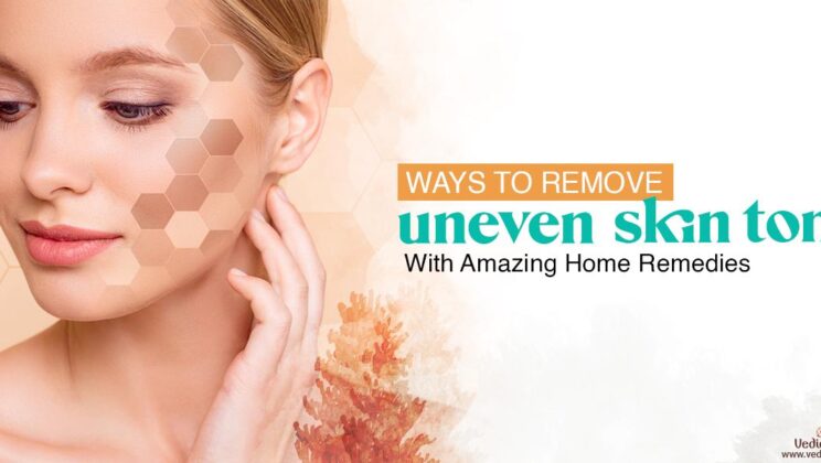 Ways to Remove Uneven Skin Tone With Amazing Home Remedies