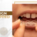 Invisalign for Gapped Teeth