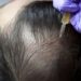 PRP hair treatment cost