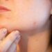 Acne During Pregnancy